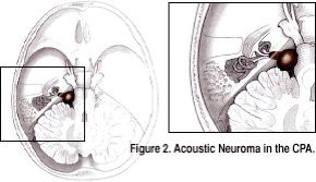 Acoustic Neuroma in the CPA