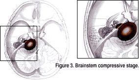 Brainstem Compressive Stage