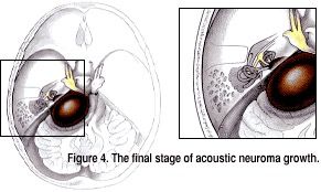 Final Stage of Acoustic Neuroma Growth