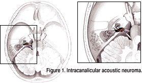 Intracanalicular Acoustic Neuroma