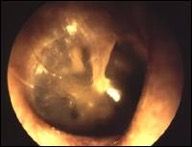 Normal Tympanic Membrane