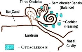 Otosclerosis, Otolaryngology⁠ — Head & Neck Surgery