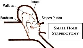 Small Hole Stapedotomy