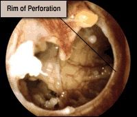 Tympanic Membrane Perforation